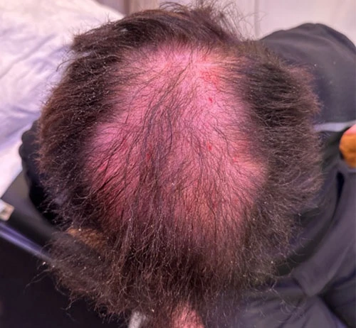 PRP Hair Restoration