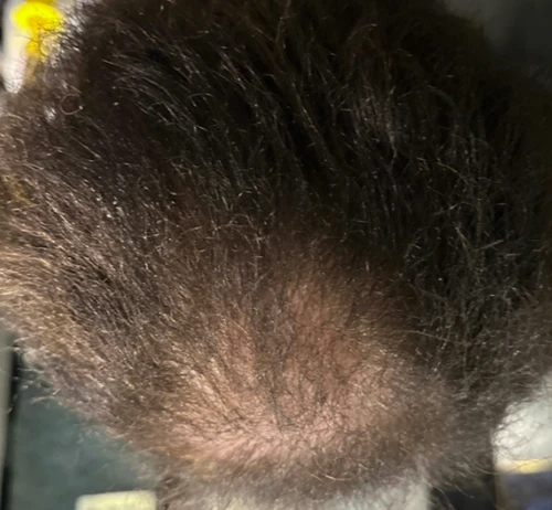 PRP Hair Restoration