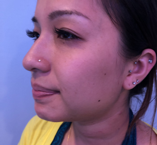 Chin Filler