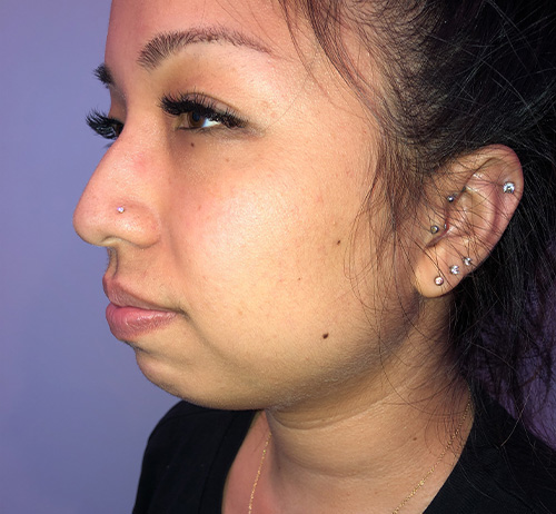 Chin Filler