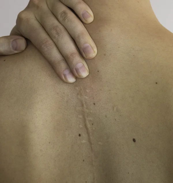 Woman touching long scar on her back