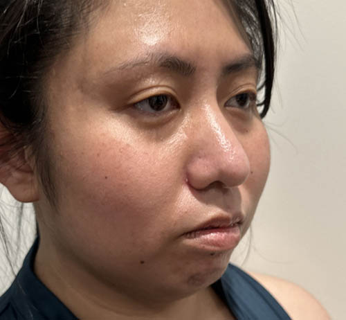Chin Filler