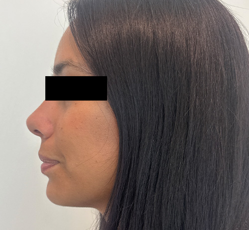 Chin Filler