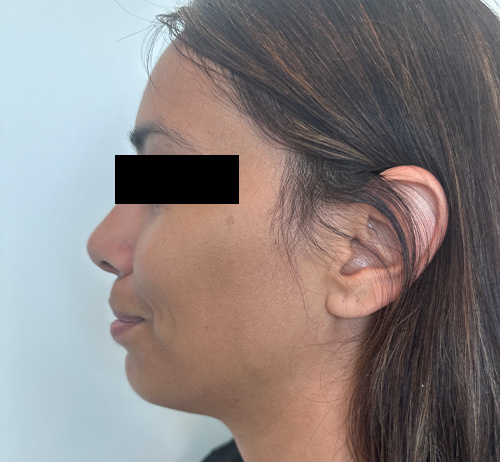 Chin Filler